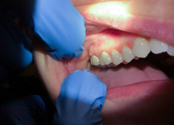 Best Emergency Denture Repair in Vernon Center, NJ